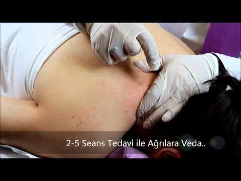 Kuru İğneleme Tedavisi