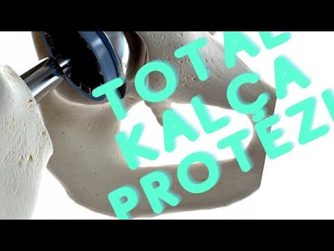Kalça eklemi kireçlenmesi total kalça Protezi