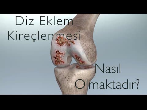 Diz kireçlenmesi nasıl olmaktadır?