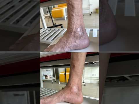 Varis Hastalığının İhmal Edildiğinde Oluşturduğu Tablo